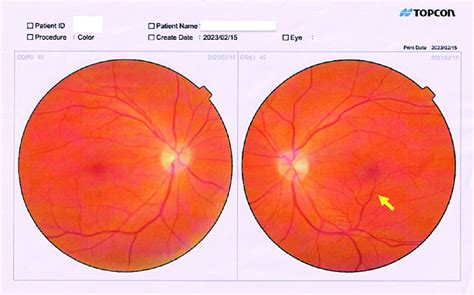 Color fundus photographs of the right eye (OD) and left eye (OS ...