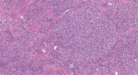 Fibrothecoma of the ovary | MyPathologyReport.ca