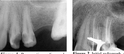 [PDF] Endodontic Treatment of a Maxillary First Premolar with Type IV ...