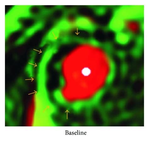 Volume-rendered micro-CT imaging of a coronary plaque and vasa vasorum ...