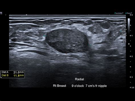 Small Parts | Aplio i-series Clinical Gallery | Ultrasound | Canon Medical Systems USA