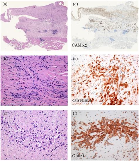 Surgical pleural biopsy tissue showing (a) thickened parietal pleura... | Download Scientific ...