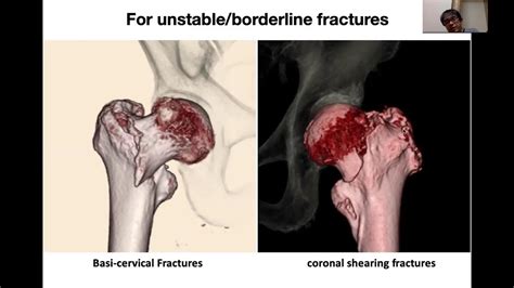 MJOM May 26 TresLock for basicervical fracture - YouTube