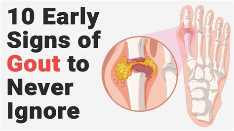 Gout Uric Acid Symptoms | SexiezPix Web Porn