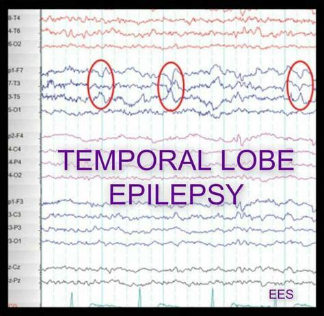 Temporal Lobe Epilepsy | Temporal lobe epilepsy, Epilepsy, Epilepsy ...