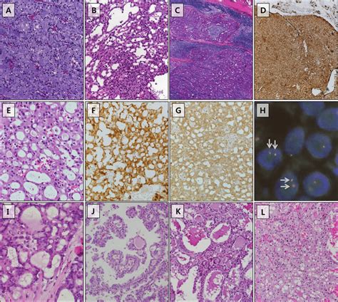 Histologic features of acinic cell carcinoma and ETV6... | Download ...