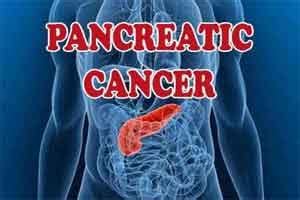 Radiation Therapy Pancreatic Cancer - All About Radiation