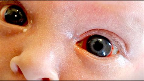 HELP! My Newborn Has Blood in the White of His Eyes (Subconjunctival Hemorrhage) - YouTube