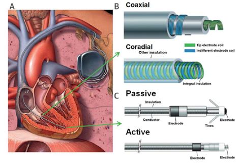 An illustration of a typical pacemaker system with pacemaker leads... | Download Scientific Diagram