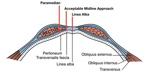 Identifying the Linea Alba & Avoiding Paramedian Incisions During Midline Celiotomy | Clinician ...