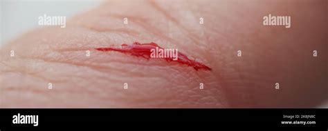 Man with injured finger, bleeding blood on open cut wound Stock Photo - Alamy