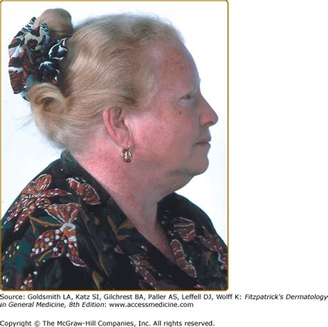 Albinism and Other Genetic Disorders of Pigmentation | Plastic Surgery Key