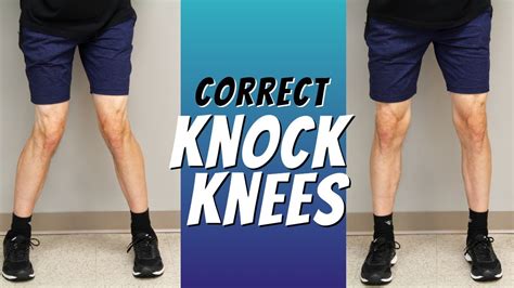 Top 5 Ways to Correct Knock Knees with Exercise Etc. - YouTube