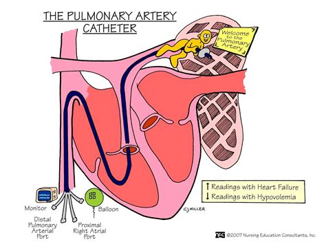 Pa Catheter Ports And Placement Catheter Insertion Catheter Pulmonary ...