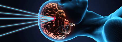 Introduction to SRS | Hellenic Stereotactic Radiosurgery Society