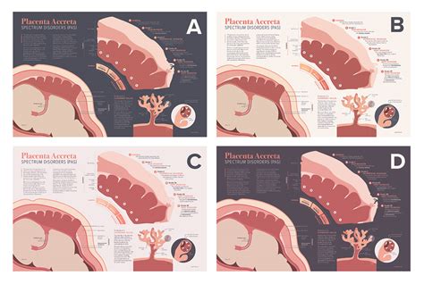 Placenta Accreta Spectrum Disorders on Behance