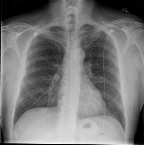 File:Chest x-ray - posteroanterior view.jpg - Wikimedia Commons
