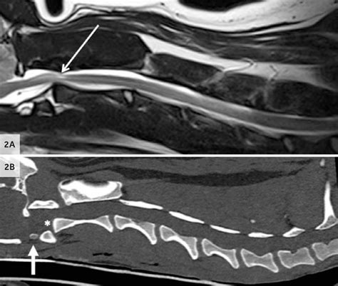 Unusual case of atlantoaxial instability - CVS Referrals