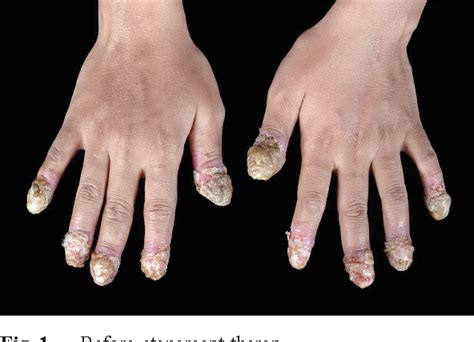 Figure 1 from A recalcitrant acrodermatitis continua of Hallopeau successfully treated with ...