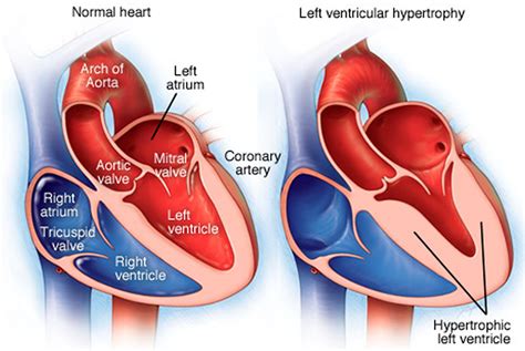 Left Ventricular Hypertrophy - Causes, Symptoms, Diagnosis & Treatment