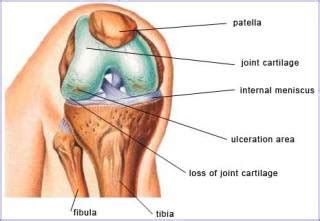 Medical Advice from top Medical Article.: Joint Effusion in Knee : Symptoms