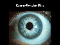 Kayser-Fleischer ring - wikidoc