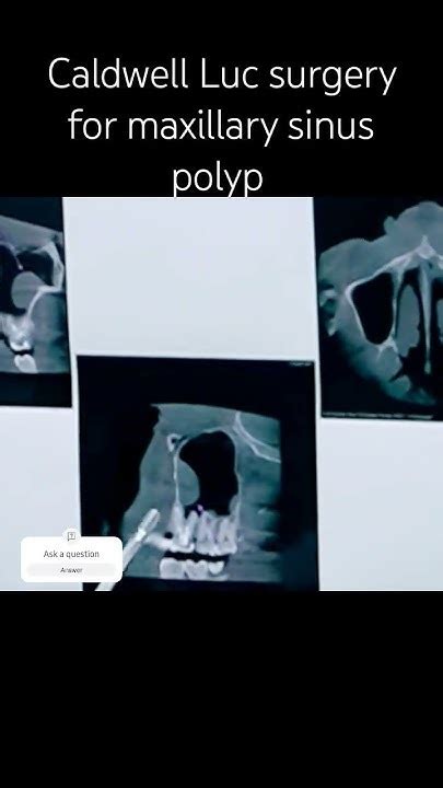 Maxillary Sinus Polyp Surgery by Oral and Maxillofacial surgeon ...