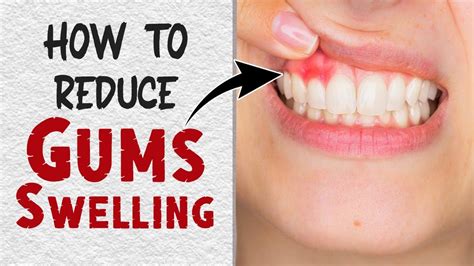 How to Reduce Gum Swelling Fast || Home Remedies for Swollen Gums Treatment - YouTube