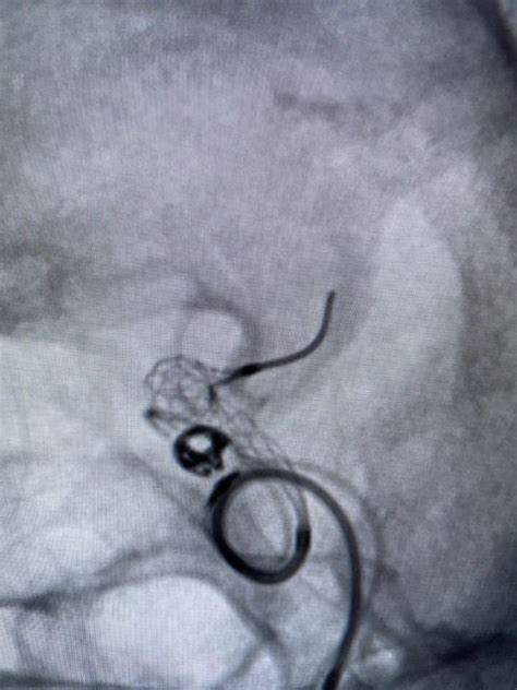 Avoid Using a Stent