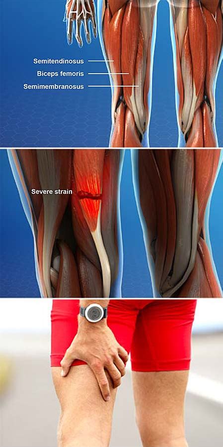 Hamstring Muscle Injuries | Central Coast Orthopedic Medical Group