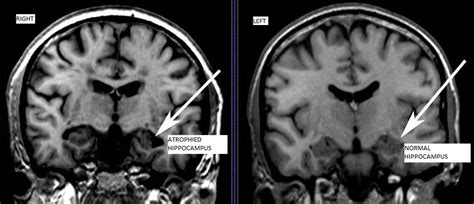 Cureus | The Neuroprotective Effects of Exercise on Cognitive Decline: A Preventive Approach to ...