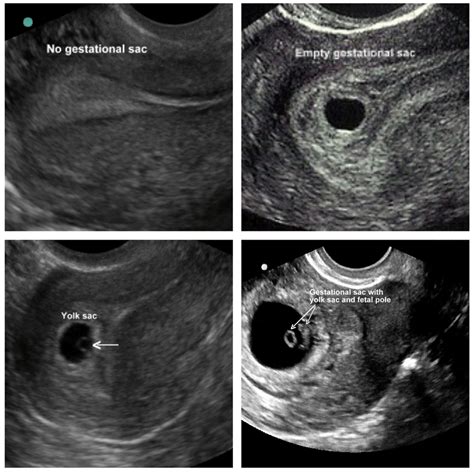 Clinical Concepts in Pelvic Ultrasound — Taming the SRU