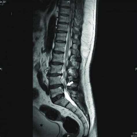 Lumbar Spine Mri Herniation