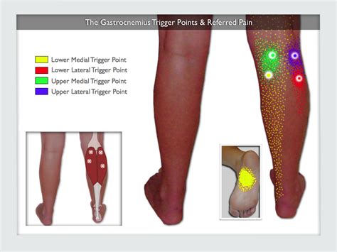 Upper Calf Tendonitis