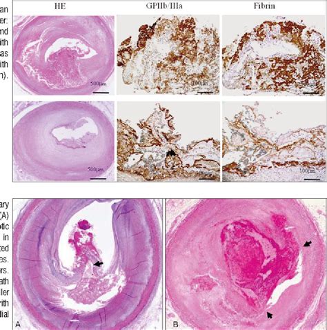 THROMBUS FORMATION ON DISRUPTED PLAQUES | Semantic Scholar