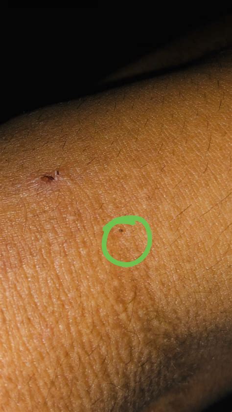 HELP! TINY BLACK BUGS ARE RUNING MY LIFE. Extremely itchy bites (25 in the past 3 days) and I’ve ...