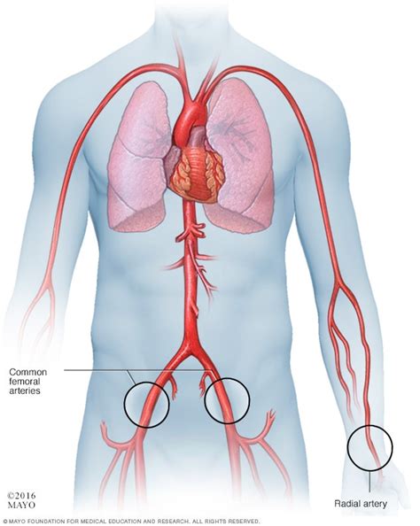 Coronary angiogram - Mayo Clinic
