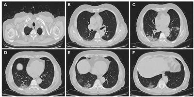 Frontiers | Association of Lung CT Findings in Coronavirus Disease 2019 (COVID-19) With Patients ...