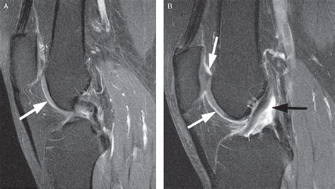 Assessment of synovitis with contrast-enhanced MRI using a whole-joint semiquantitative scoring ...