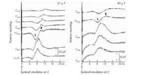 Variability In Somatosensory Evoked Potential Test: Summing It Up