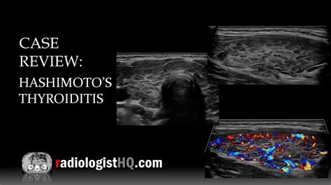 Normal Thyroid Ultrasound