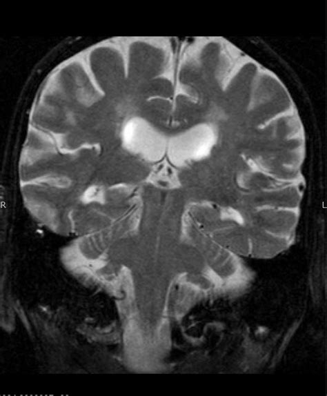 Ocular Motility » Wisdom in Diagnostic Imaging » College of Medicine » University of Florida