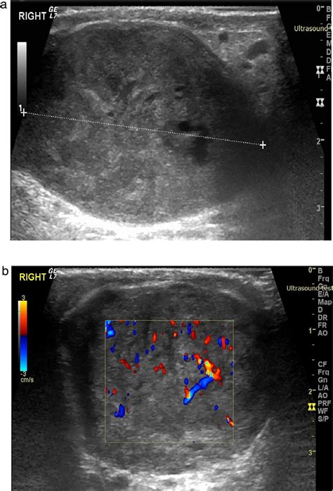 Scrotal Anatomy Ultrasound