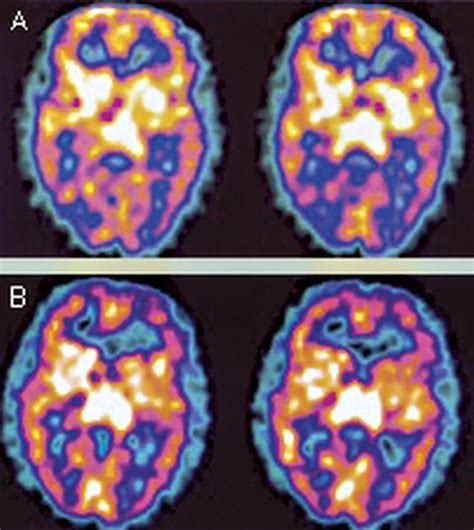 LOOKING AT LYME DISEASE - MSIDS: WHAT CAUSES WHITE MATTER LESIONS IN THE BRAIN OF PATIENTS WITH ...