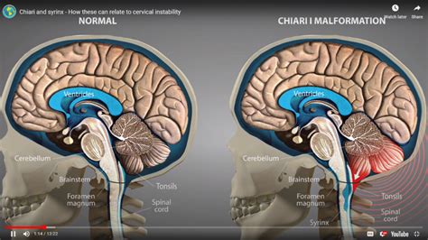 Cerebellar tonsillar ectopia herniation and Chiari 1 malformation ...