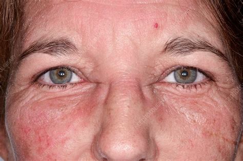 Angioedema - Stock Image - C034/5314 - Science Photo Library