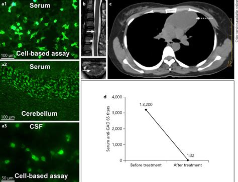 Figure 1 from Glutamic Acid Decarboxylase Antibody in a Patient with Myelitis: A Retrospective ...