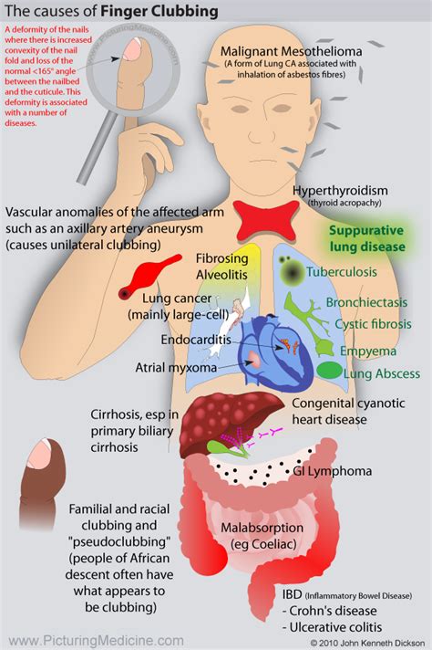 Causes of VTE Venous Thromboembolism or DVT Deep Vein Thrombosis ...