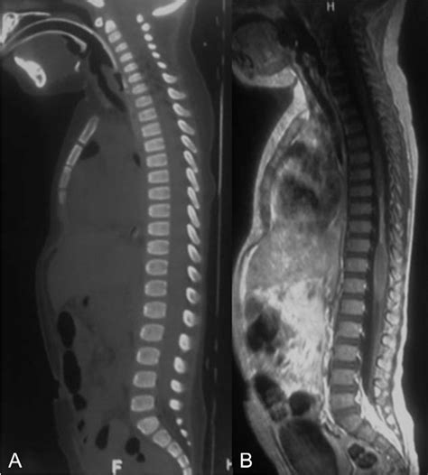 Figure 1 from Thoracic spinal cord injury without radiologic abnormality in a pediatric patient ...