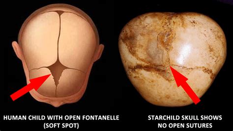 Did the Starchild Skull have Progeria?